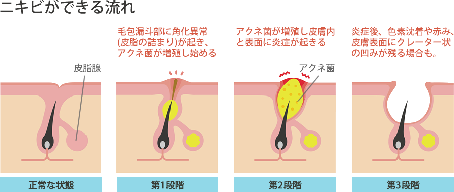 ニキビができる流れ 